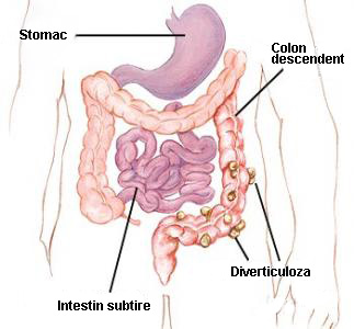 pierderea în greutate după obstrucția intestinului mic