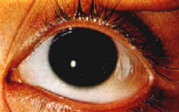 oftalmologie: sindrom de ochi uscat)
