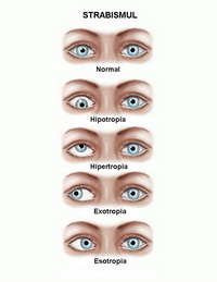 Ambliopia sau “ochiul leneș” - Clinica OFTAPRO