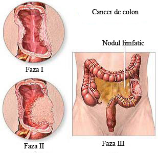 cancerul colorectal simptome hpv virusu nedir belirtileri nelerdir