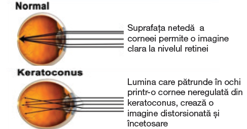 refacerea vederii cu keratoconus