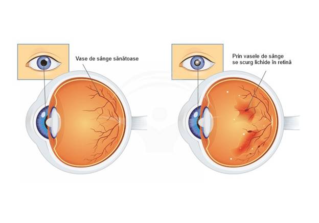 Afecțiuni retiniene