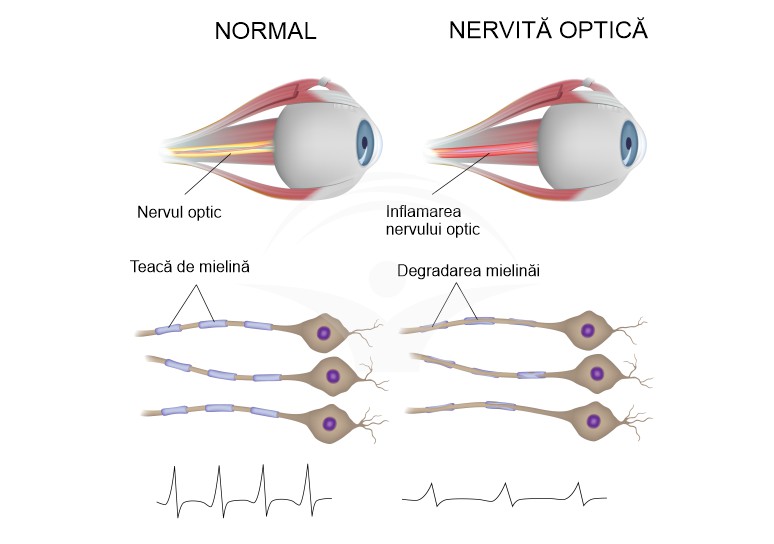 Patologii ale nervului optic