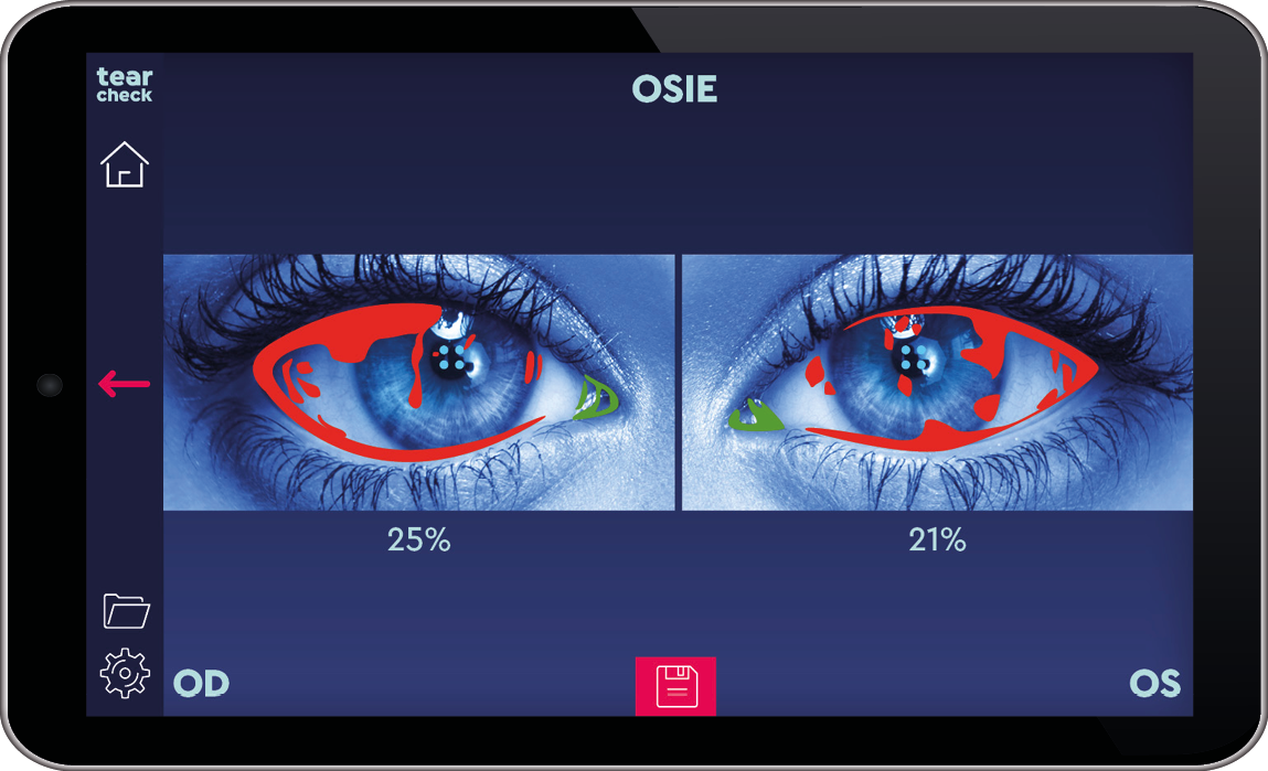 E-Eye și tratamentul ochiului uscat