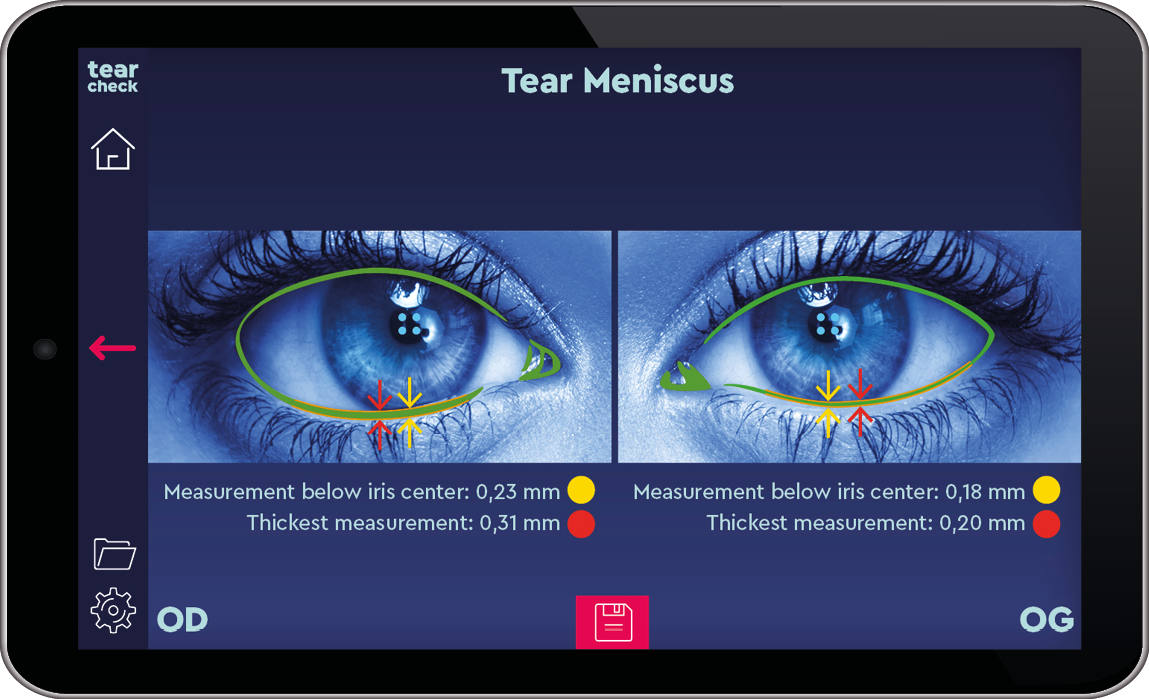 Meniscul lacrimal TearCheck